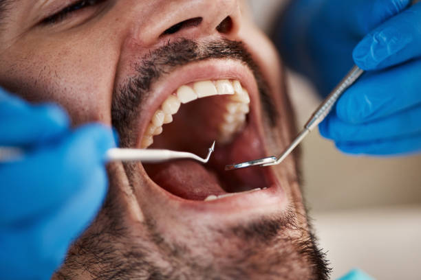 Best Emergency Gum Treatment in El Macero, CA
