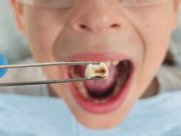 Best Emergency Tooth Extraction in El Macero, CA